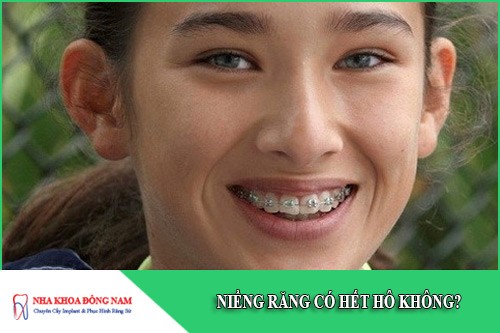 niềng răng có hết hô không