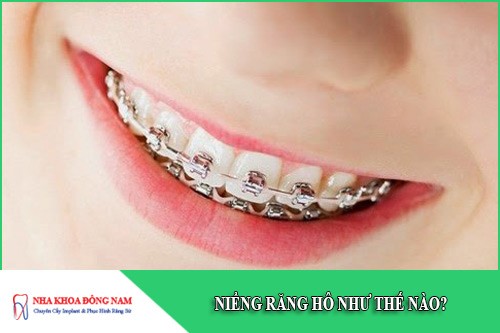 niềng răng hô như thế nào