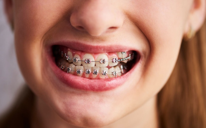 Niềng răng khắc phục tình trạng răng thụt vào nghiêm trọng