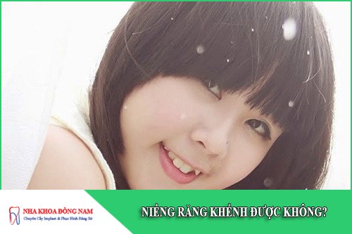 niềng răng khểnh được không