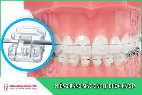 niềng răng mắc cài tự buộc là gì