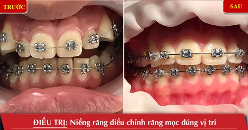 trước và sau khi niềng răng