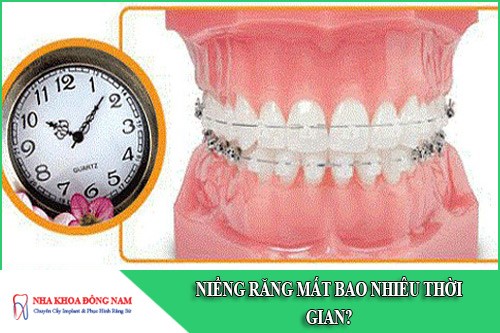 niềng răng mất bao nhiêu thời gian