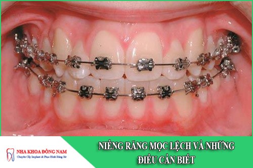 niềng răng mọc lệch và những điều cần biết