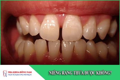 niềng răng thưa được không