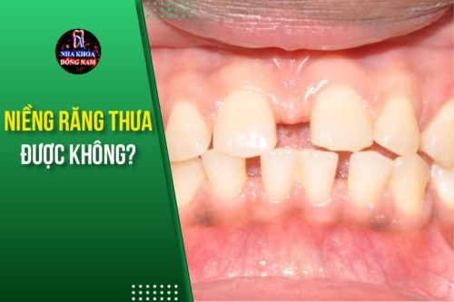 niềng răng thưa được không