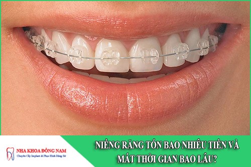 niềng răng tốn bao nhiêu tiền và mất thời gian bao lâu