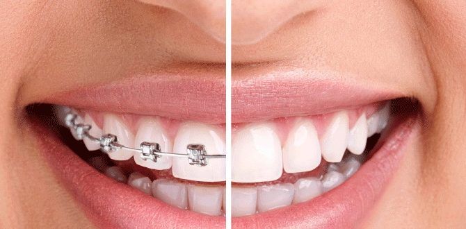 điều trị răng mọc lệch bằng phương pháp niềng răng và bọc răng sứ
