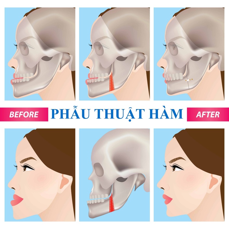 Phẫu thuật hàm cho trường hợp răng thụt vào do xương