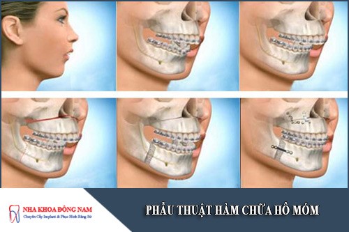 phẫu thuật hàm chữa hô móm