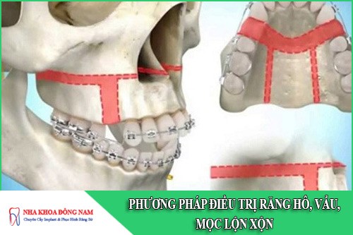 phương pháp điều trị răng hô, vẩu, mọc lộn xộn