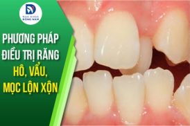 phương pháp điều trị răng hô, vẩu, mọc lộn xộn