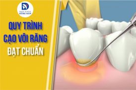 quy trình cạo vôi răng đạt chuẩn hiện nay