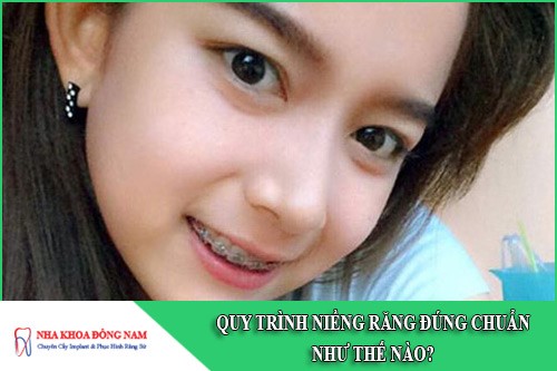 quy trình niềng răng đúng chuẩn