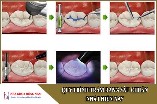quy trình trám răng sâu chuẩn nhất hiện nay