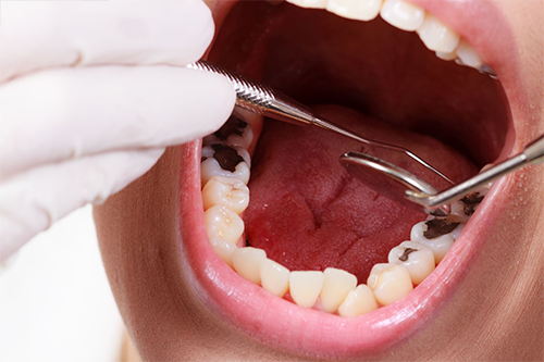 Quy trình trám răng sâu chuẩn nhất hiện nay - Nha Khoa Đông Nam®