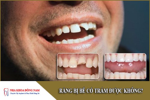 răng bị bể có trám được không