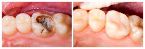 trước và sau khi trám răng