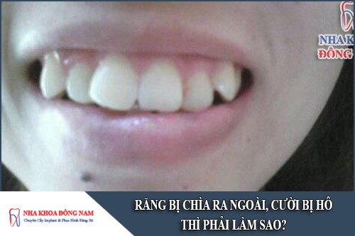 răng bị chìa ra ngoài, cười bị hô thì phải làm sao