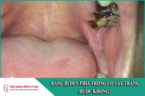 răng bị đen ở phía trong có tẩy trắng được không