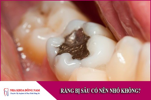 răng bị sâu có nên nhổ không