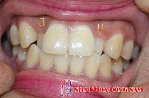 răng mọc lệch bị thụt vào trong