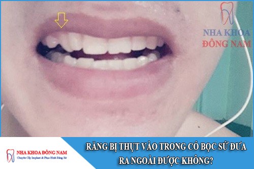 răng bị thụt vào trong có bọc sứ đưa ra ngoài được không