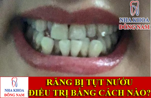 răng bị tụt nướu thì điều trị bằng cách nào -1