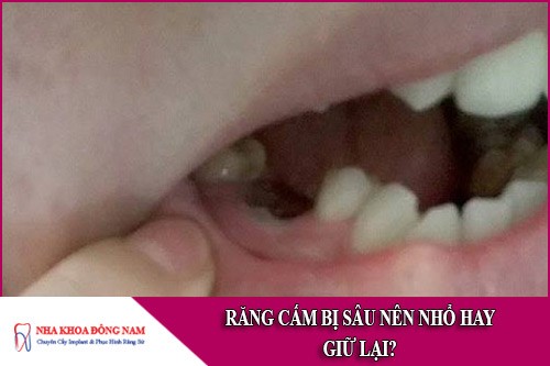 răng cấm bị sâu nên nhổ hay giữ lại