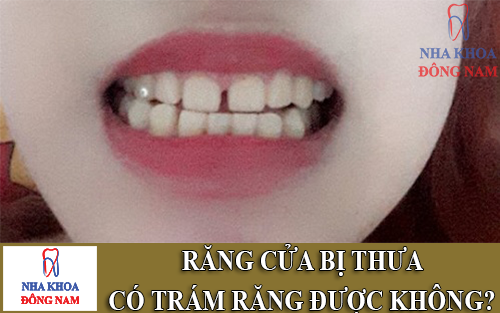 răng cửa bị thưa có trám răng được không -1