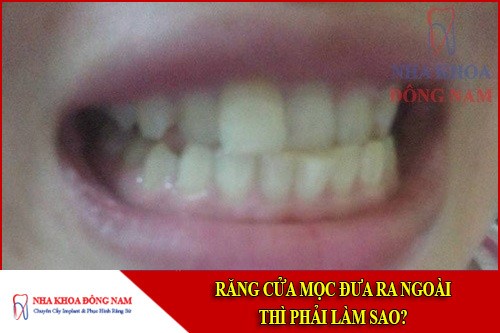 răng cửa mọc đưa ra ngoài thì phải làm sao