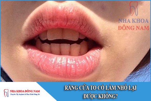 răng cửa to có làm nhỏ lại được không