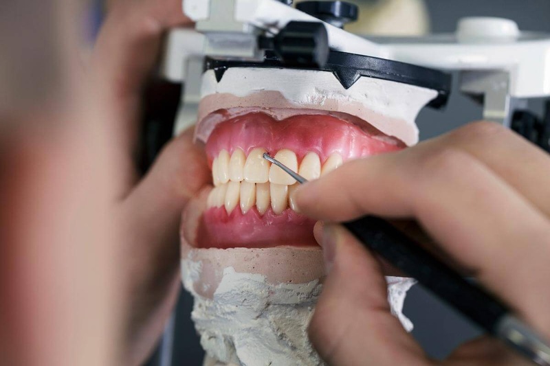 Răng giả Composite bị đổi màu theo thời gian