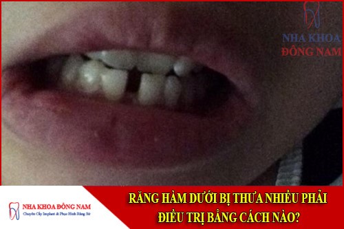 răng hàm dưới bị thưa phải điều trị bằng cách nào