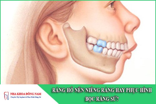răng hô nên niềng răng hay phục hình bọc răng sứ