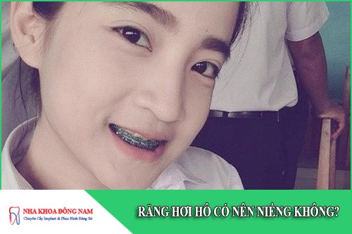 răng hơi hô có nên niềng không