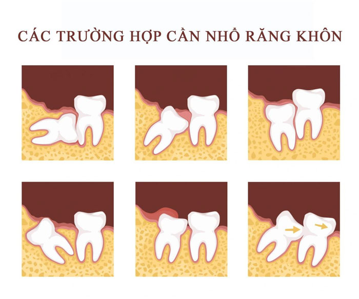 Răng khôn mọc lệch mọc ngầm cần nhổ bỏ sớm