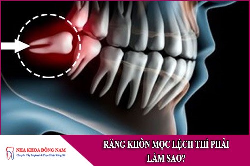 răng khôn mọc lệch thì phải làm sao