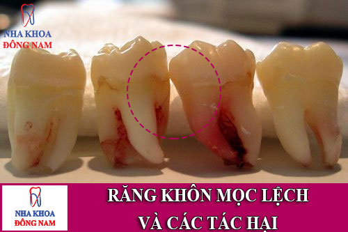 Răng khôn mọc lệch và các tác hại