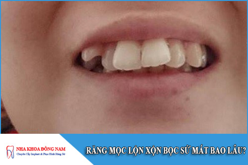 răng mọc lộn xộn bọc sứ mất bao lâu
