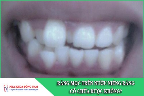 răng mọc trên nướu niềng răng chữa được không