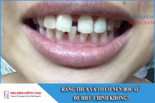 răng thưa và to có nên bọc sứ không