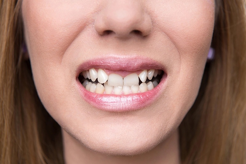 Răng thụt vào trong gây ảnh hưởng đến thẩm mỹ