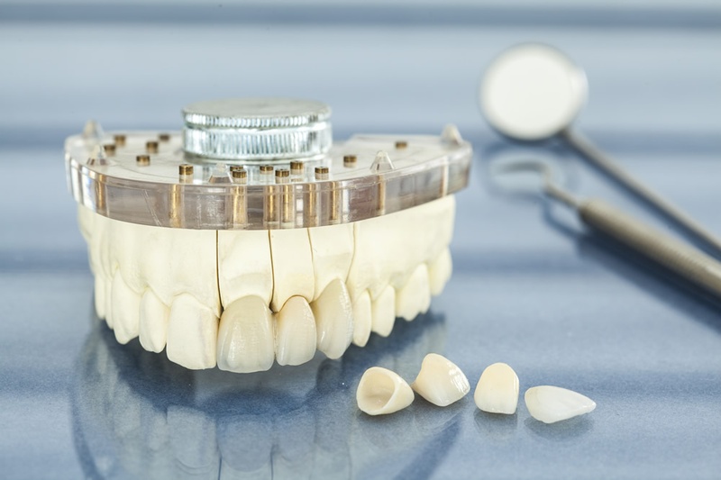 Răng toàn sứ mang lại giá trị thẩm mỹ cao