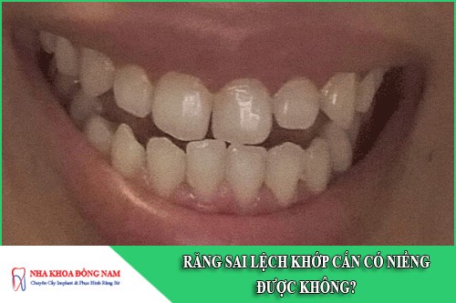 răng sai lệch khớp cắn có niềng được không