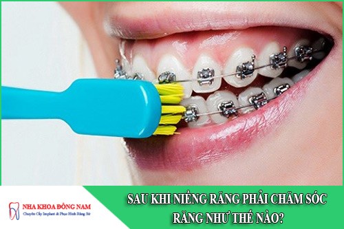 sau khi niềng răng phải chăm sóc răng như thế nào