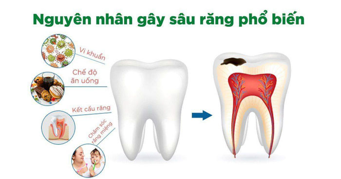 Sâu răng do nhiều nguyên nhân gây nên