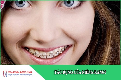 tác dụng của niềng răng
