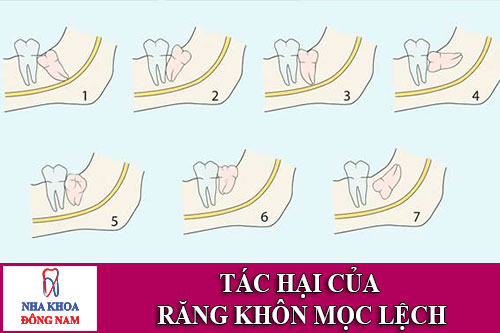 tác hại của răng khôn mọc lệch