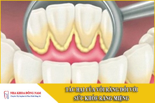 tác hại của vôi răng đối với sức khỏe răng miệng